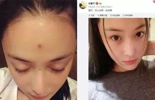 那些明星长痘痘,揭秘明星护肤战“痘”记